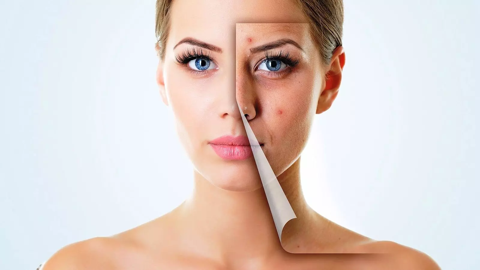 ¿Cómo eliminar las cicatrices de acné? Remedios y tratamientos