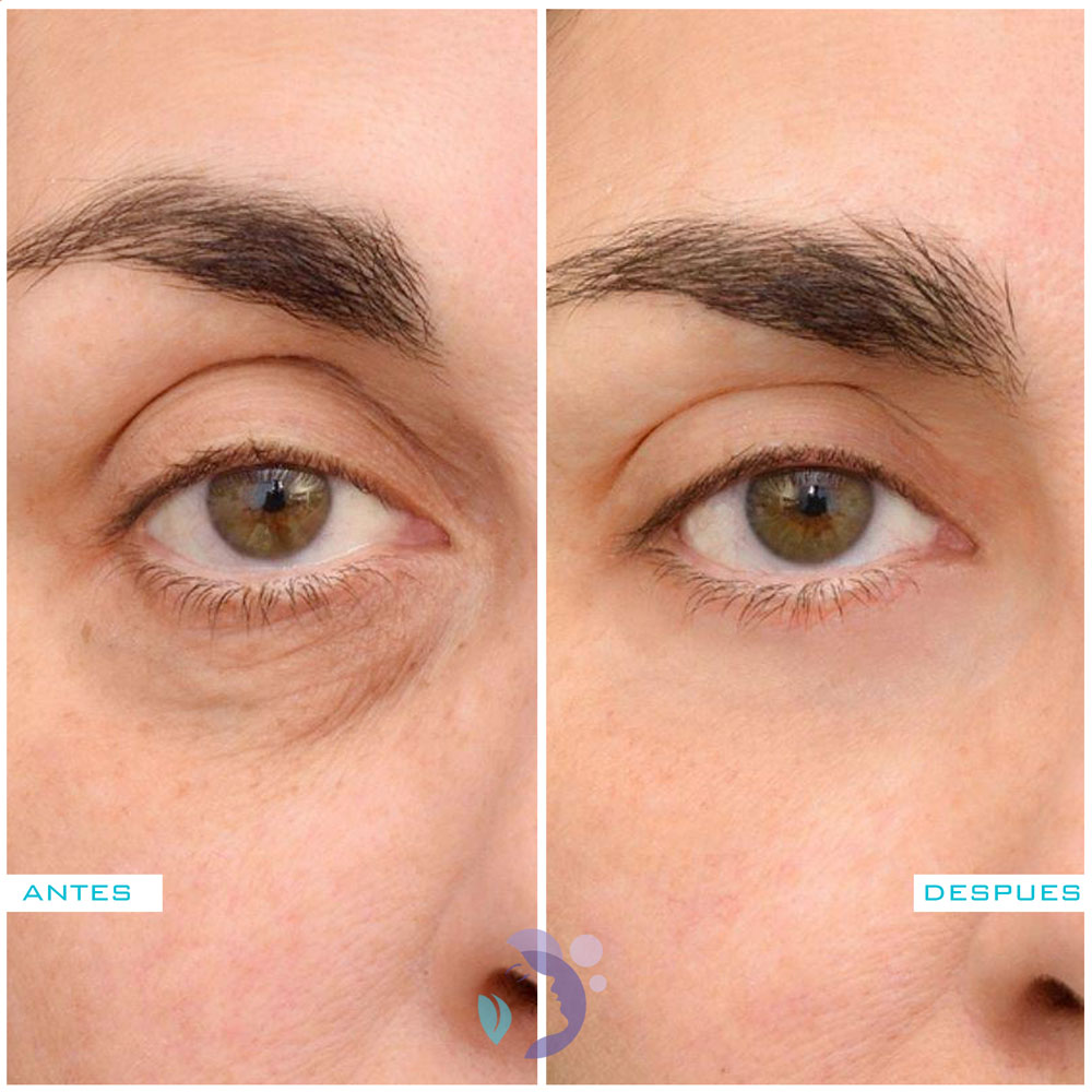 Eyes Defition con Ácido Hialurónico | Precios ️ - Piel Bella